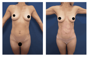 Liposuction meaning