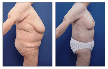 High definition liposuction Los Angeles