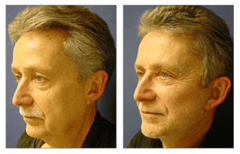 Facelift Side Effects