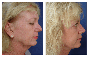 Facelift Pictures Right After Surgery