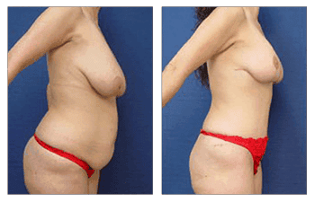 Tummy tuck Newport Beach
