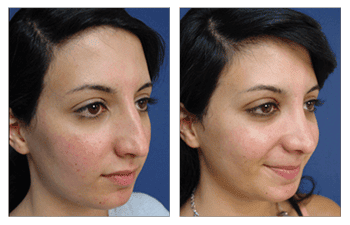 Open Rhinoplasty Recovery