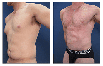 Mini Tummy Tuck Recovery Stories