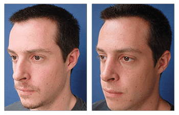 nose job Los Angeles