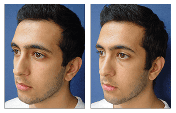 Crooked Nose Causes