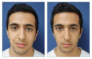 Crooked Nose Causes