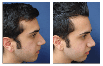 Crooked Nose Surgery Before and After