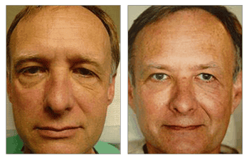 Types of Dermal Fillers