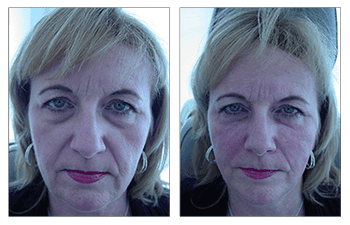 Fillers for Face Prices