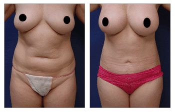 Mini Tummy Tuck After C Section