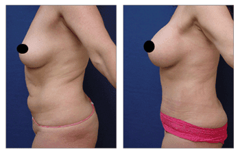 Buttock enhancement Newport Beach