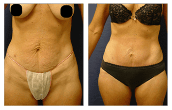 Mini Tummy Tuck Near Me