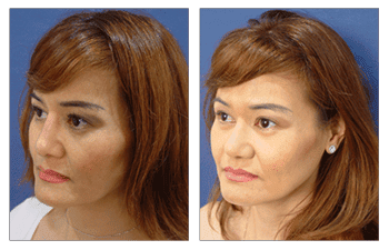 Revision Rhinoplasty