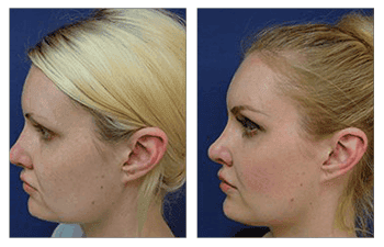 Nose Job Laguna Beach