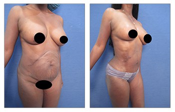 Liposuction Recovery