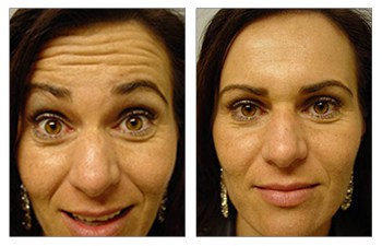 Botox Allergan