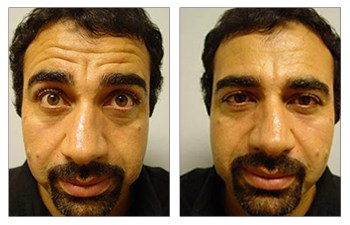 Botox Meaning