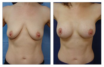 Breast Lift Recovery