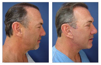 face and neck lift procedure Beverly Hills