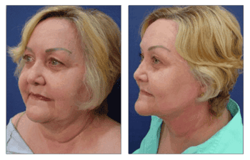 VIORA Reaction Patient