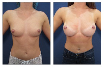 Breast Lift Beverly Hills