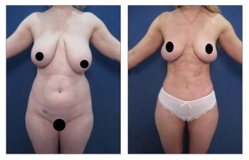 HD lipo with breast reduction