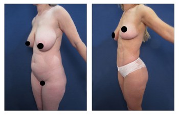 High Definition Liposuction Results