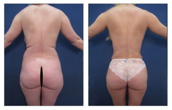 High Definition Liposuction with BBL