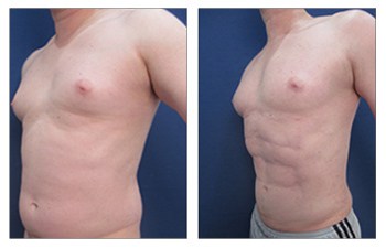 left front oblique High Definition Abdominal Contouring For The Large Weight Loss Male Patient