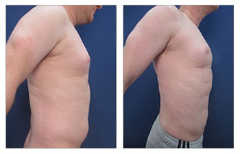 right side High Definition Abdominal Contouring For The Large Weight Loss Male Patient
