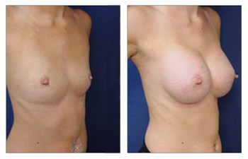 right front oblique Breast Implant Augmentation Recovery