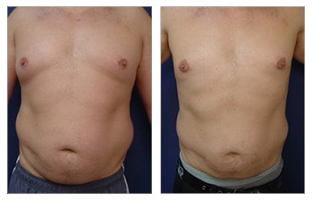 Best Gynecomastia Doctor