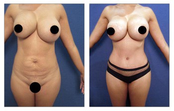 Renuvion Reviews