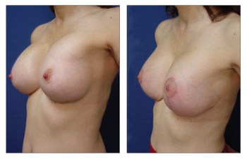 Breast Augmentation Revision Of Surgical Error In Pocket Dissection