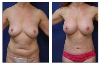 Mommy Makeover With Upper Belly Fullness
