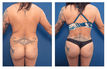 Buttock Enhancement Cosmetic Plastic Surgery Institute