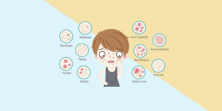 CBD Oil For Acne