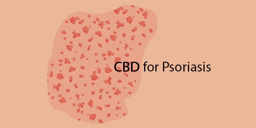 Can CBD Treat Psoriasis?