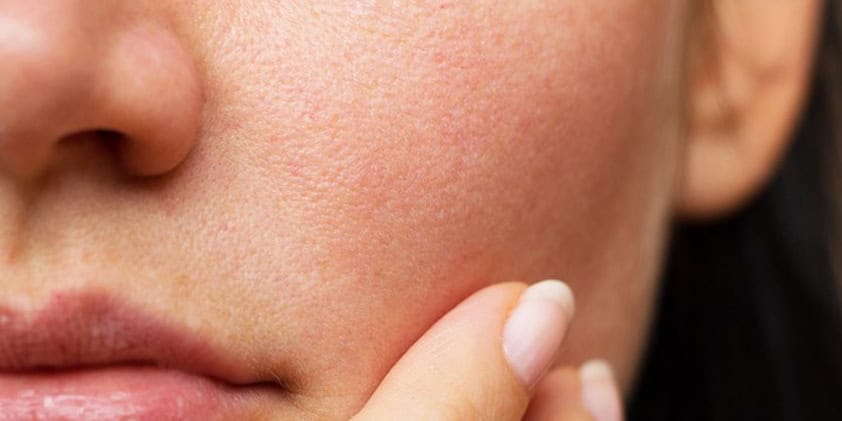 What Skin Conditions Can CBD Oil Treat?