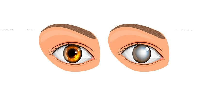 CBD For Cataracts