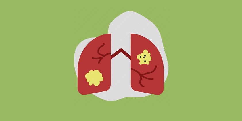 Does CBD Have the Potential To Help Fight Lung Cancer?