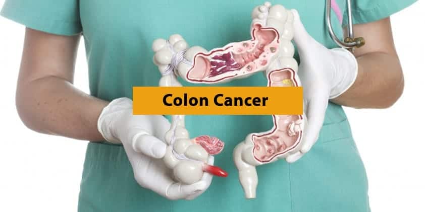 How CBD Can Help in the Fight Against Colon Cancer