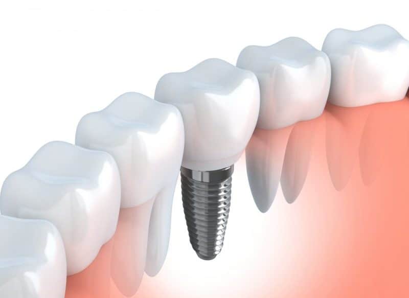 cropped-dentalimplant-e1580680368601.jpg cropped dentalimplant e1580680368601