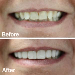 tony veneers tony veneers
