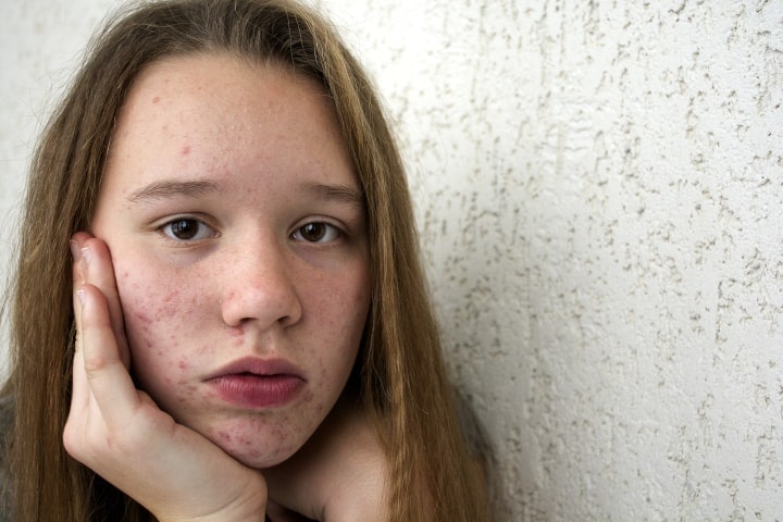 All About Teenage Acne