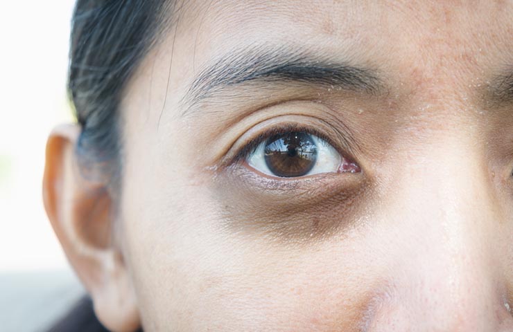 Hyperpigmentation and Dark Circles