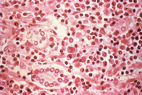 What is Hantavirus