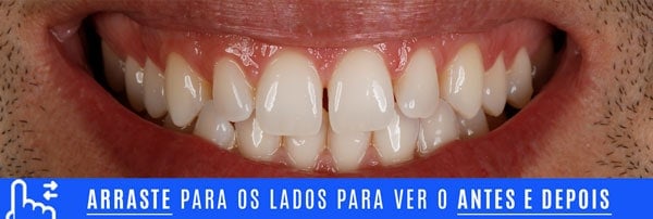 Casos Lentes 14 SORRISO INICIAL dentes pequenos aumento com lentes de contato dentais