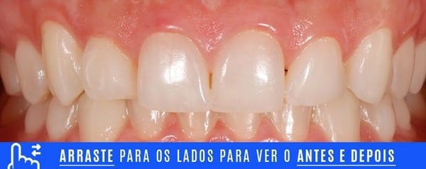 Casos Lentes 17 inicial DENTES TORTOS tratamento com laminados ceramicos
