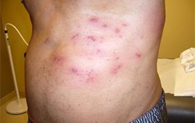 Type 2 diabetic male experiencing painful rash Type 2 diabetic male experiencing painful rash